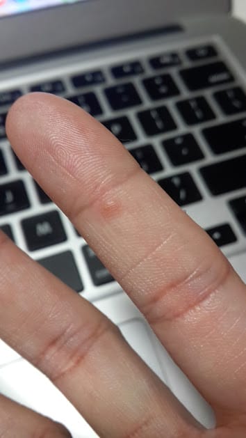 手心關節奇癢無比，原來我得了汗皰疹～～