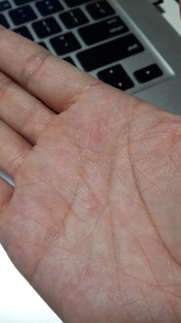 手心關節奇癢無比，原來我得了汗皰疹～～